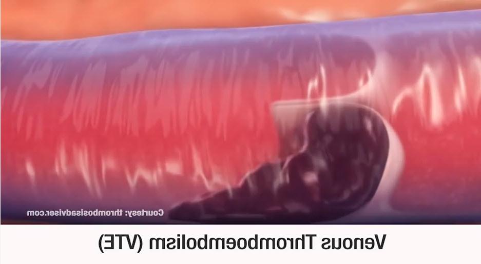 Venous thromboembolism video screenshot